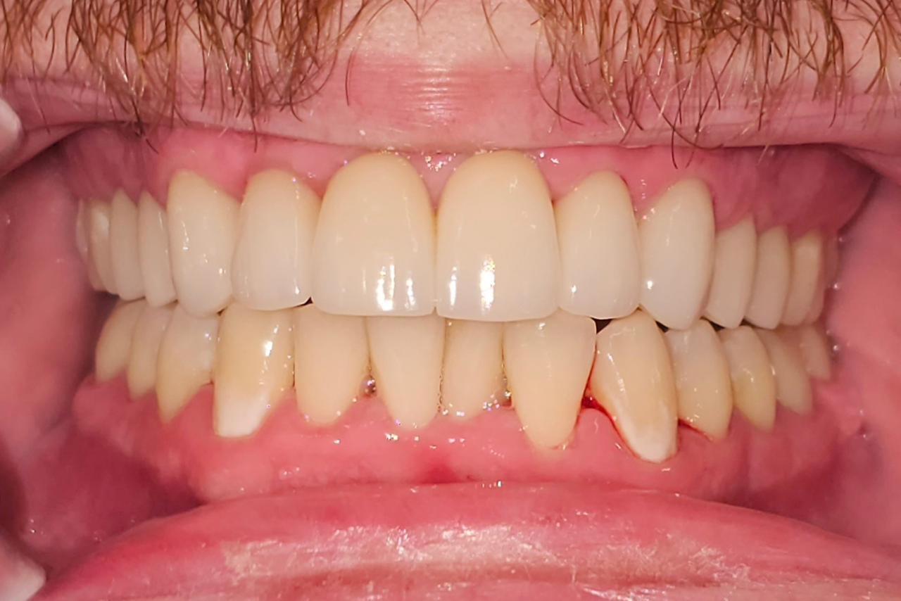 After dental implant treatment