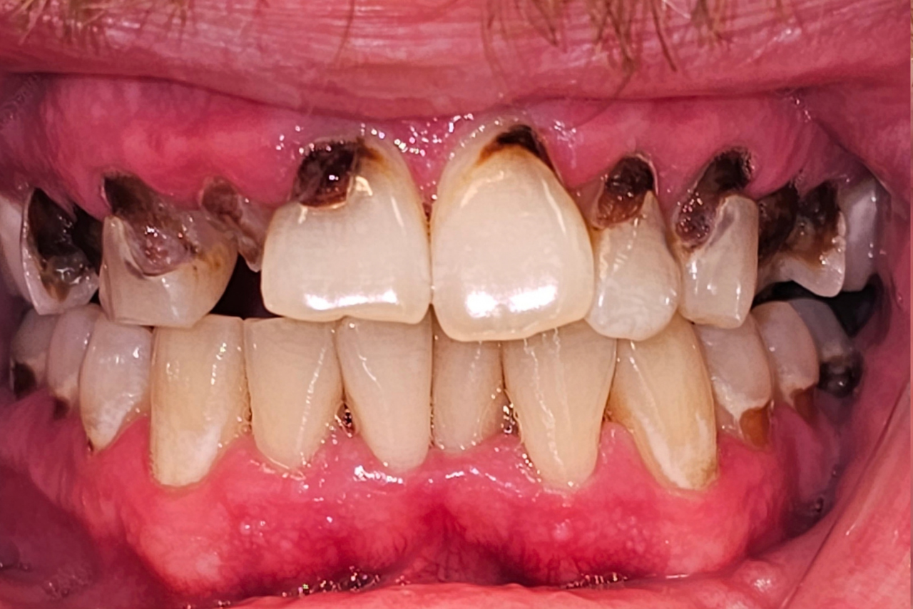 Before dental implant treatment
