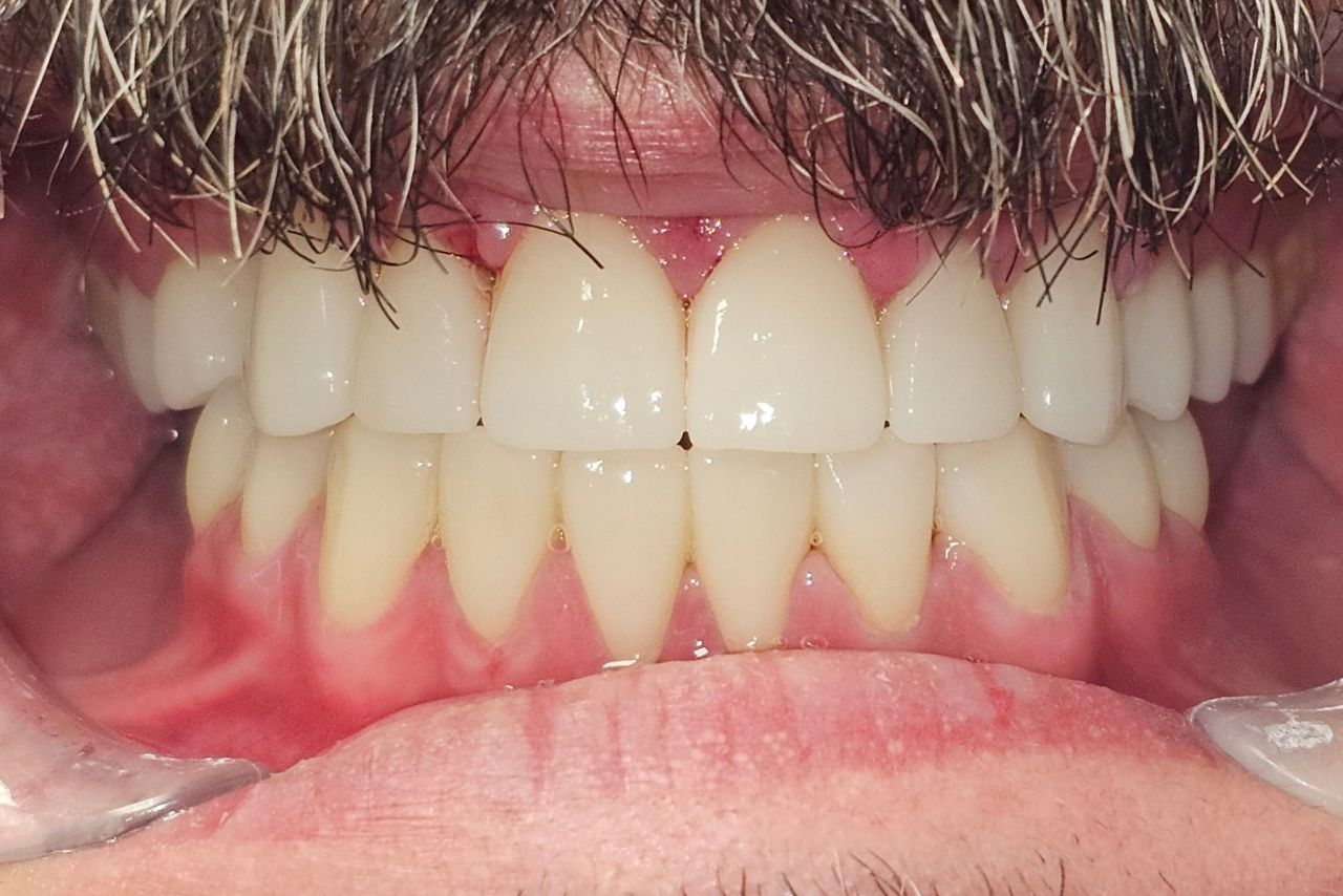 After restorative dental treatment