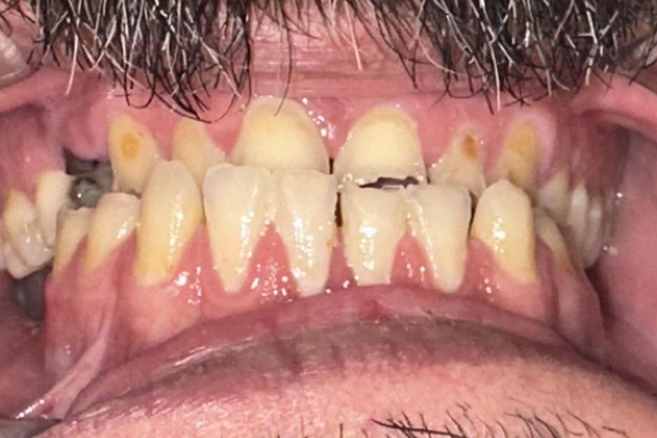 Before restorative dental treatment