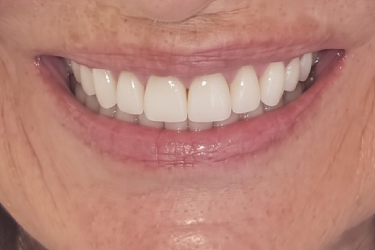 After cosmetic dental treatment