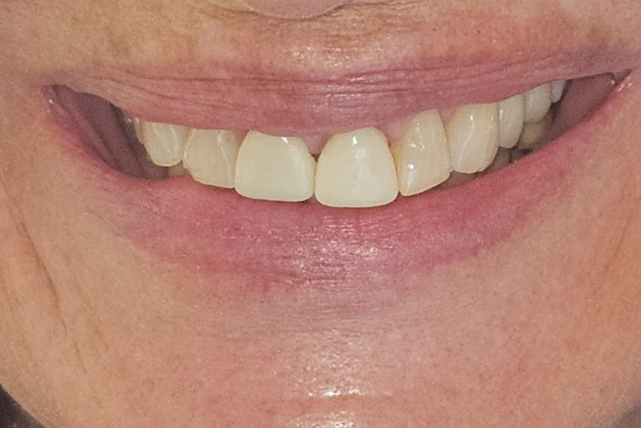 Before cosmetic dental treatment
