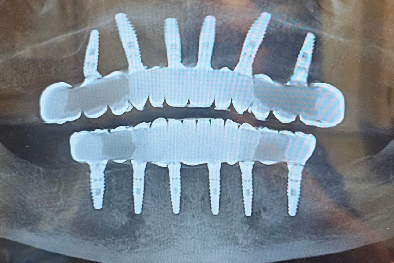 After restorative dental treatment