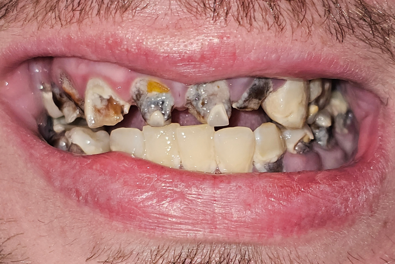 Before restorative dental treatment